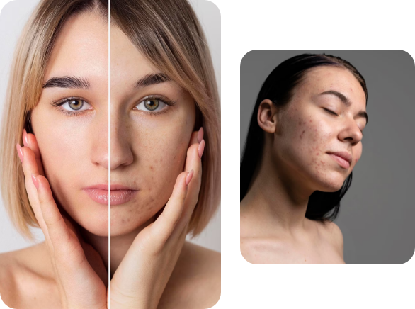 acné-Imagen de acné en la piel