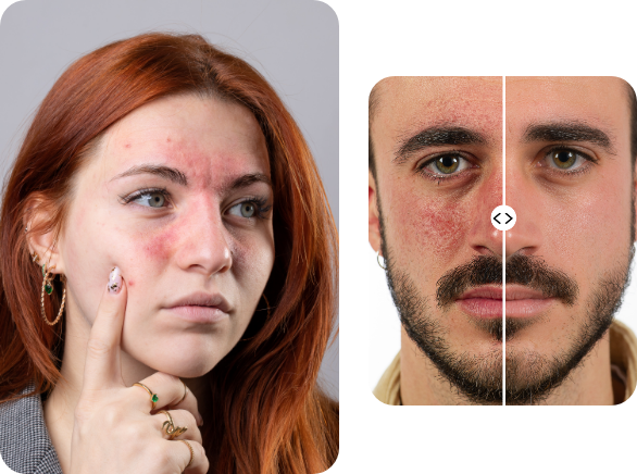 imagen-de-mujer-cuperosis-globalderm-dermatología-3