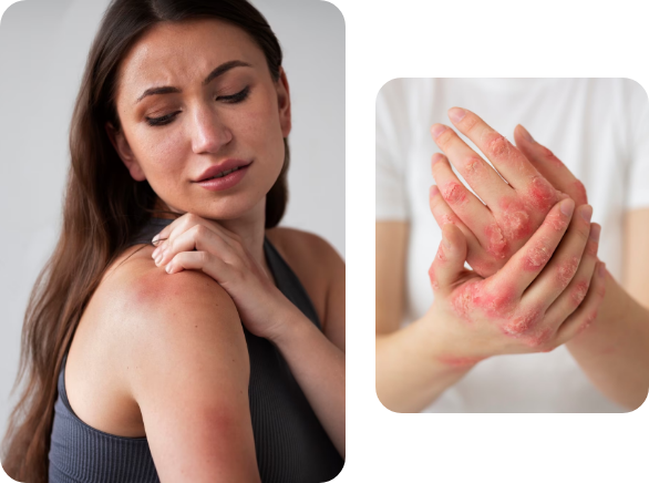 Imagen de dermatitis en la piel