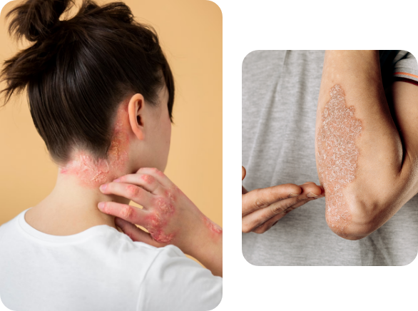 Imagen de psoriasis en la piel