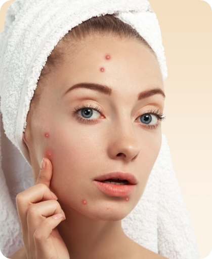 acné - Imagen de mujer con acné