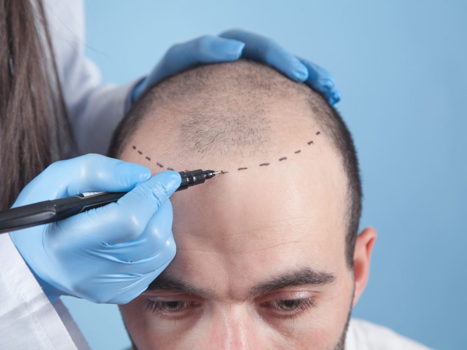 alopecia-pérdida-cabello-salud-capilar-globalderm