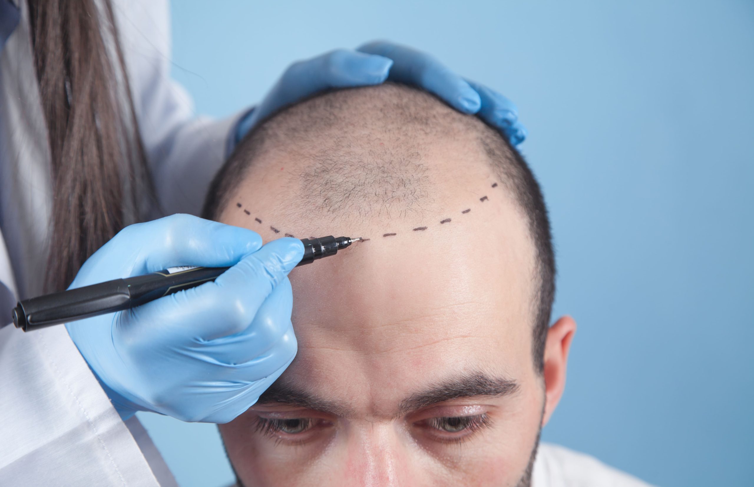 alopecia-pérdida-cabello-salud-capilar-globalderm
