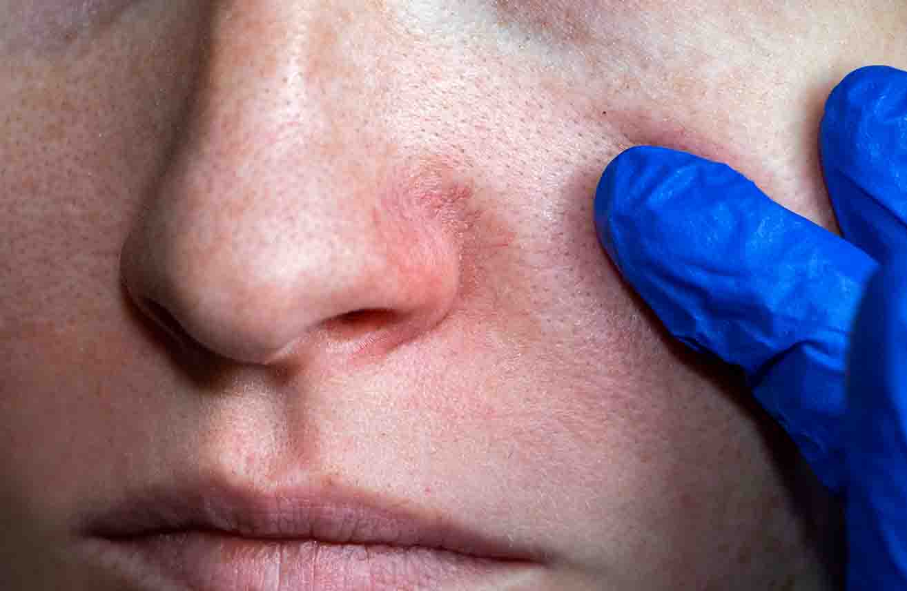 cuperosis-venas-rojas-piel-globalderm
